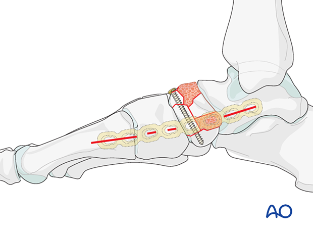 Planning for a medial plate to bridge the talonavicular joint