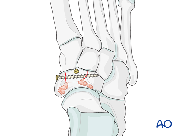 Screw fixation of a multifragmentary navicular fracture