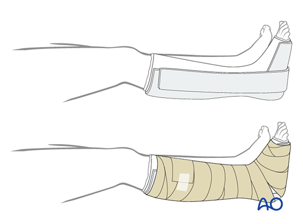 Immobilization of the foot with a three-sided plaster splint