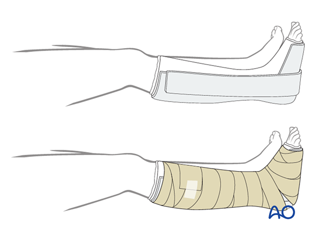 Foot immobilization