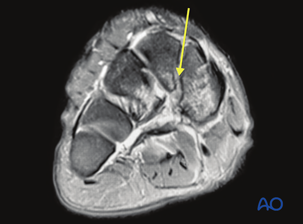 MRI may be indicated for the identification of pure ligamentous injuries.