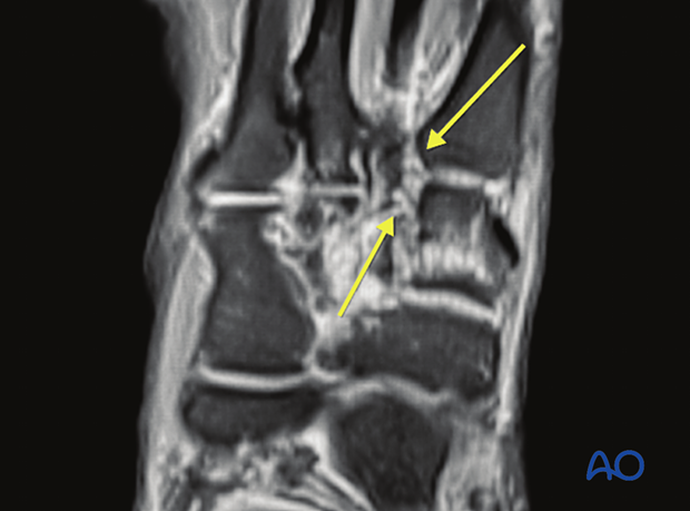 identification of pure ligamentous injuries.