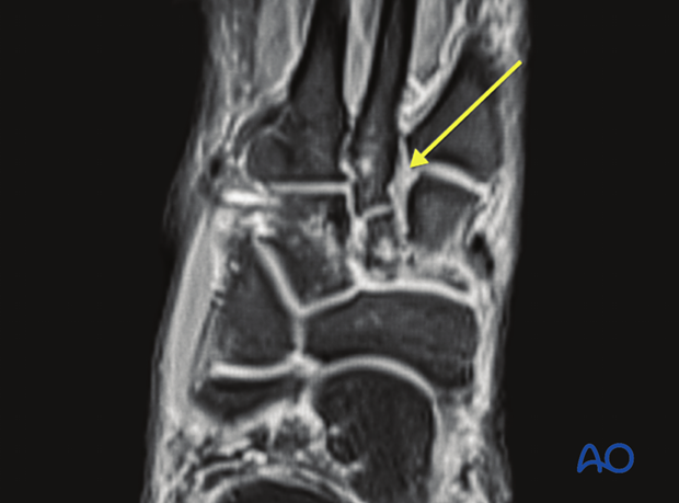 identification of pure ligamentous injuries.