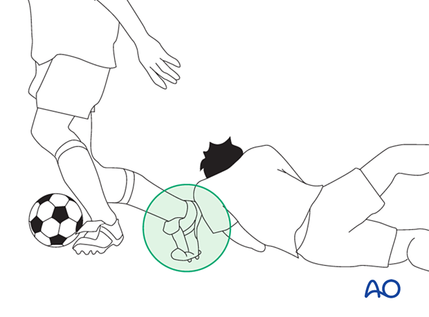 Mechanism of injury