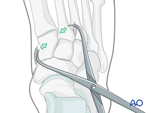 Reduction with forceps of Lisfranc injury in the foot