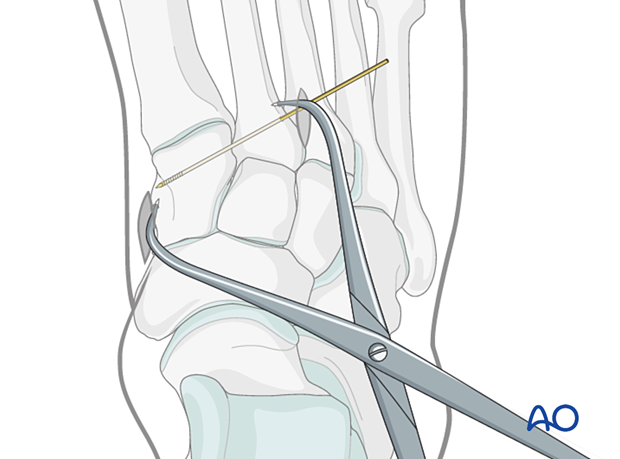 Guidewire insertion to fix Lisfranc injury in the foot