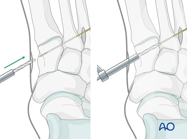 Drilling for dynamic fixation of a Lisfranc injury in the foot