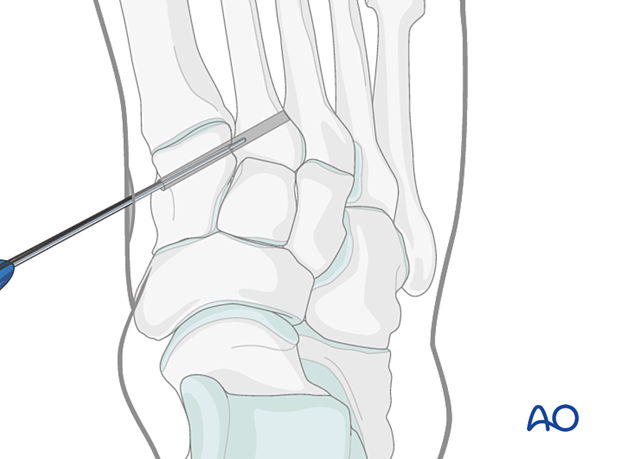 Insertion of a dynamic fixation device to treat a Lisfranc injury in the foot