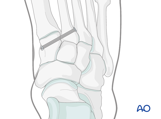 Dynamic fixation device to treat a Lisfranc injury in the foot