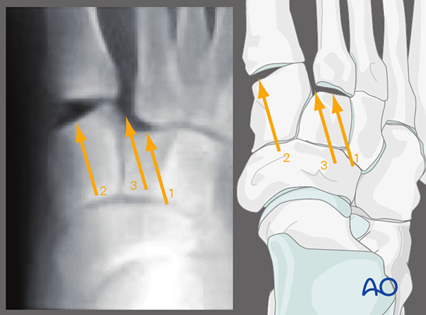 gap between 1st and 2nd metatarsal and middle and medial cuneiform