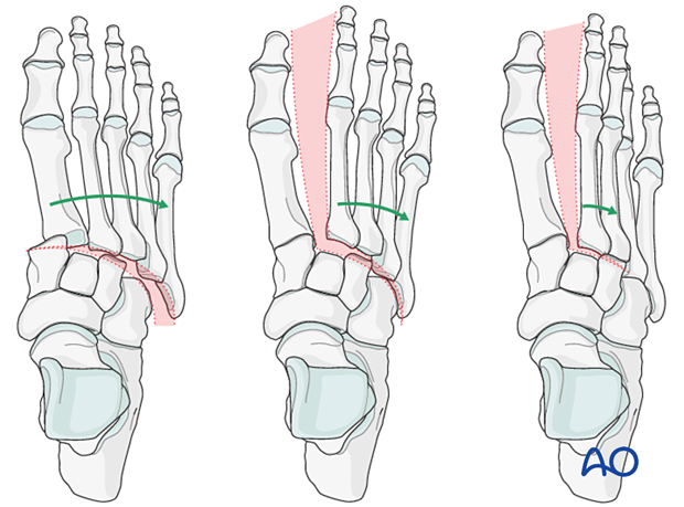 Determination of joint instability in Lisfranc injuries
