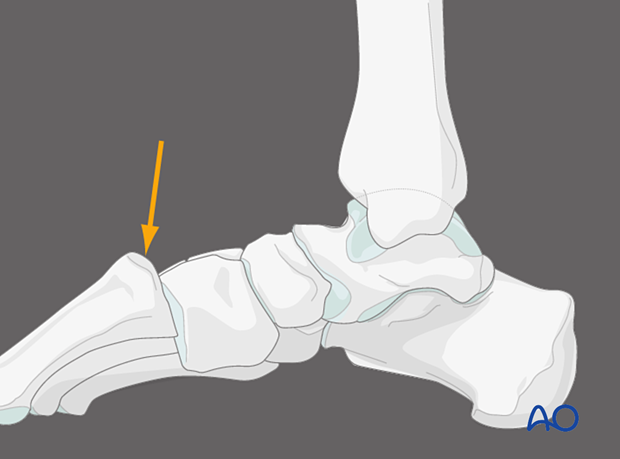 Medial view with plantar pressure over the 1st TMT joint of a Lisfranc injury