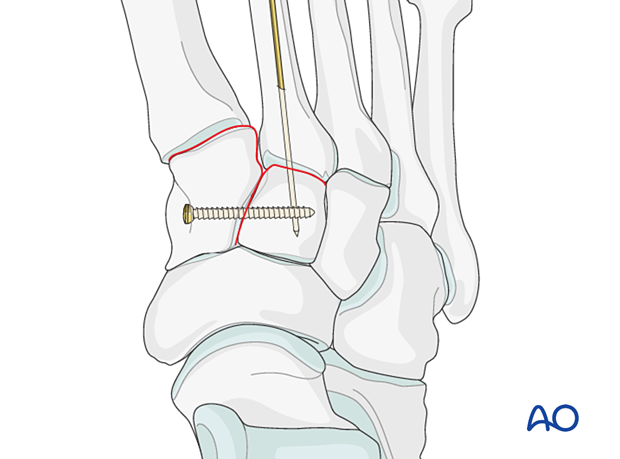 Reduction of 2nd tarsal metatarsal joints