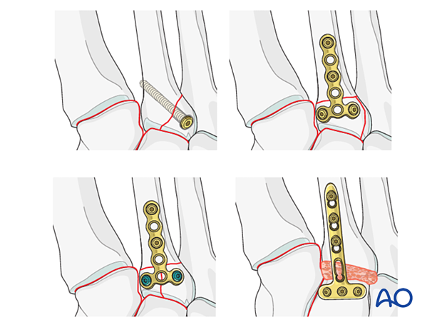 Treatment methods of fractures of the proximal 2nd metatarsal