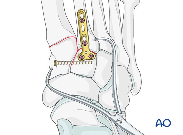 Reduction of Lisfranc instability