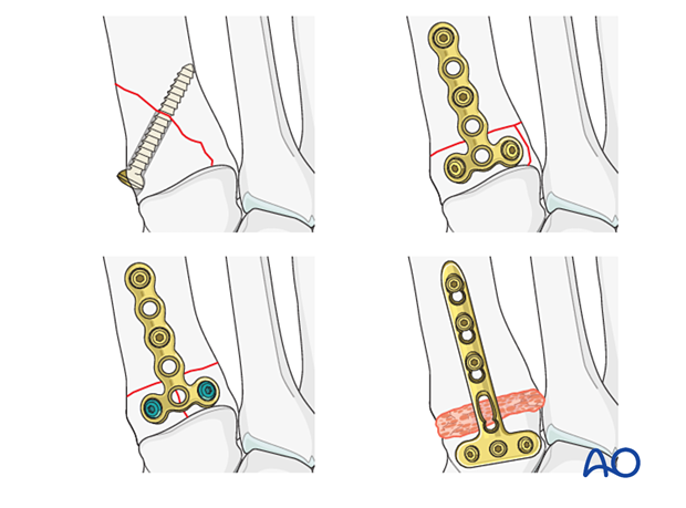 Treatment of Lisfranc instability caused by fractures of the proximal 1st metatarsal