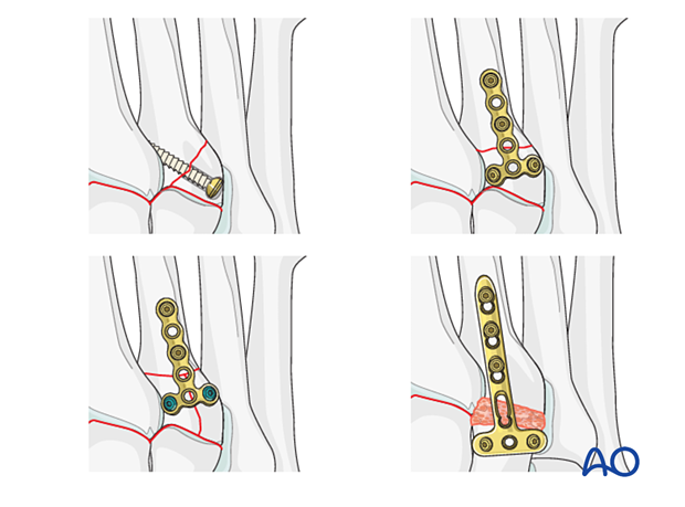 Treatment of instability caused by fractures of the proximal 3rd metatarsal