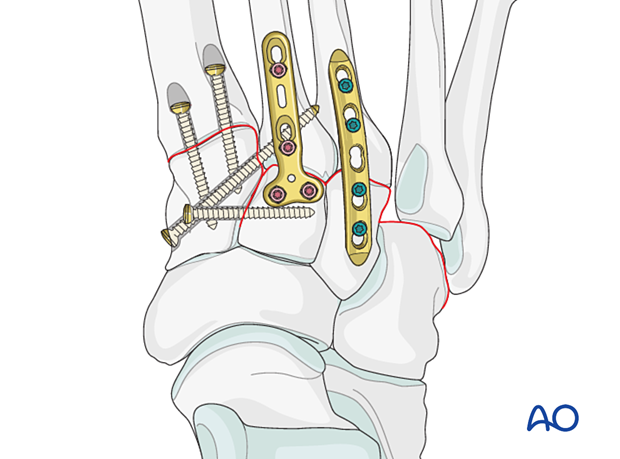 Instability 4th and 5th tarsal metatarsal joints