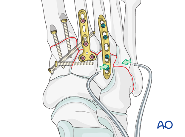 Reduction with forceps of 4th and 5th tarsal metatarsal joints
