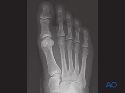 Treatment of Lisfranc injuries for Lisfranc injuries