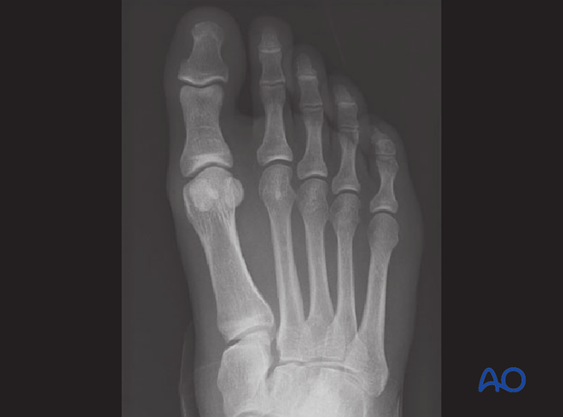This is the preoperative image of a simple ligamentous Lisfranc injury