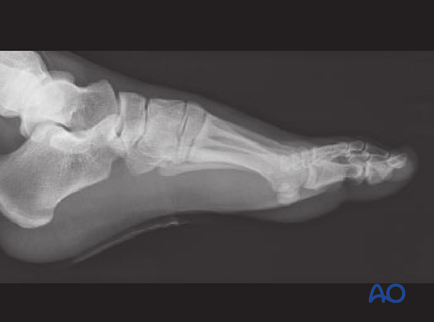 This is the preoperative image of a simple ligamentous Lisfranc injury