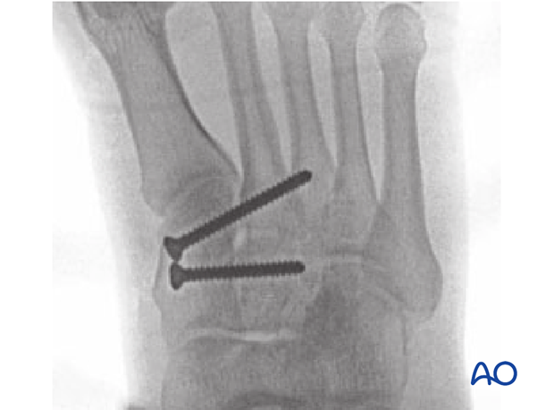Postoperative AP image of screw fixation of a simple ligamentous Lisfranc injury