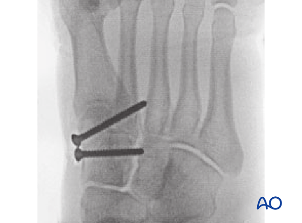 Postoperative oblique view of screw fixation of a simple ligamentous Lisfranc injury