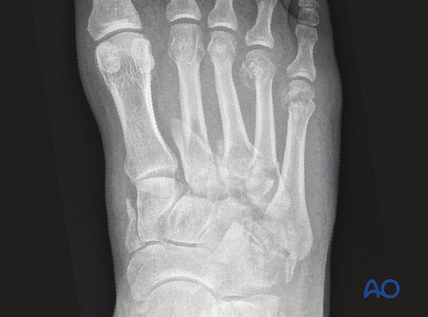 Preoperative AP view of a significant Lisfranc injury showing 2nd through 5th metatarsals injuries