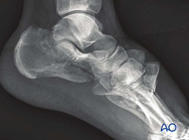 Preoperative lateral view of a significant Lisfranc injury showing 2nd through 5th metatarsals injuries