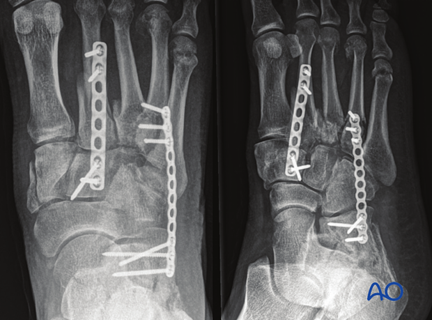 Postoperative AP and oblique view showing spanning fixation of the Lisfranc joint