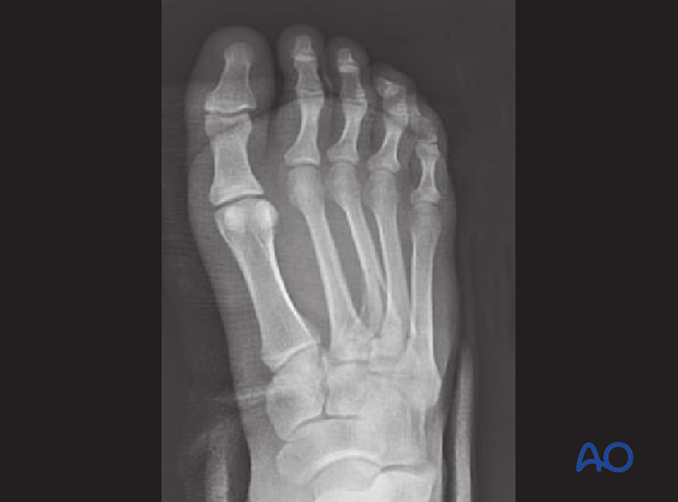 This preoperative AP image demonstrates a Lisfranc injury of the 1st, 2nd, and 3rd ray 