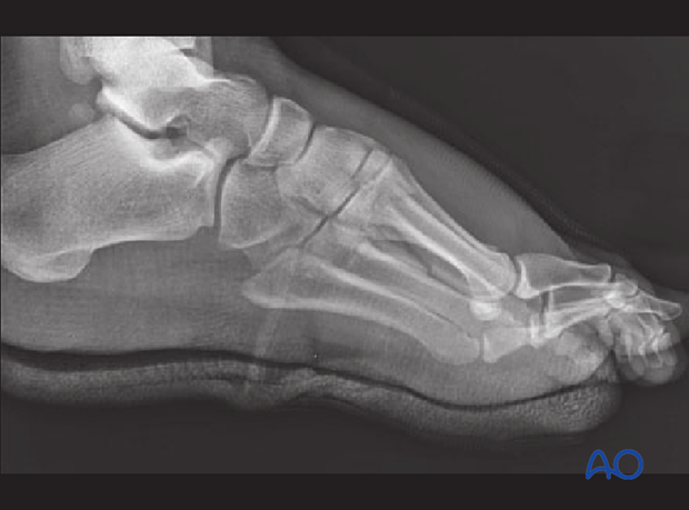 Lateral image of a Lisfranc injury of the 1st, 2nd, and 3rd ray