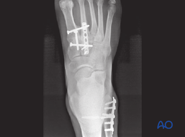 Fixation of a Lisfranc injury of the 1st, 2nd, and 3rd ray