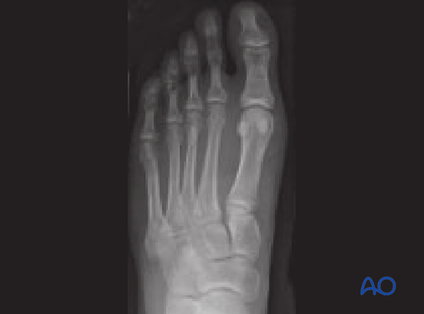 This Lisfranc injury is somewhat unique because it involves disruption between the cuneiforms and between the metatarsals