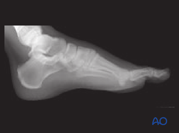 This Lisfranc injury is somewhat unique because it involves disruption between the cuneiforms and between the metatarsals