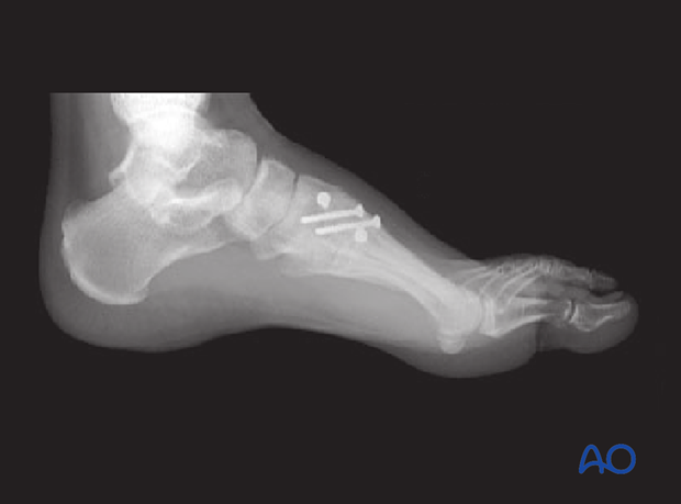 Fixation of a Lisfranc injury with disruption between the cuneiforms and between the metatarsals