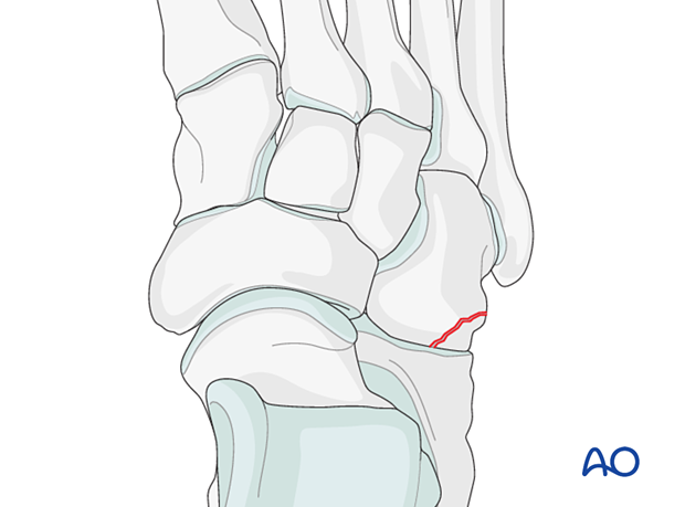 Avulsion fractures of the cuboid