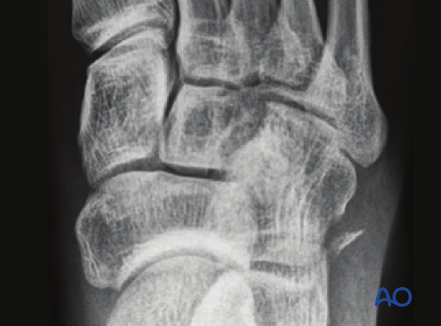 This imag shows a dorsal avulsion fracture of the cuboid.