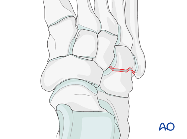 Simple articular fracture