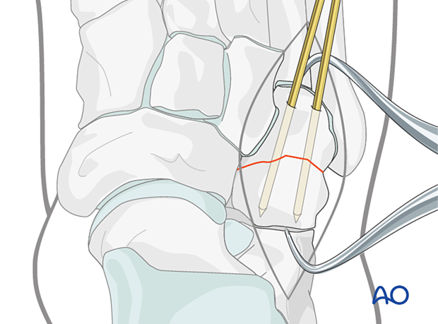 Temporary K-wire fixation of a simple cuboid fracture