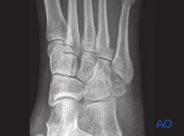 AP x-ray of a multifragmentary cuboid fracture