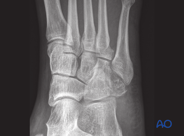 cuboid fracture healing