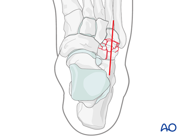 Skin incision for a dorsolateral approach to the cuboid