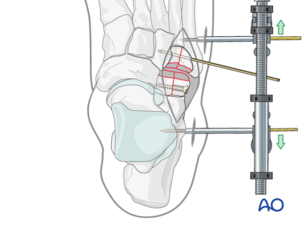 Screw fixation of articular fragments of a multifragmentary cuboid fracture