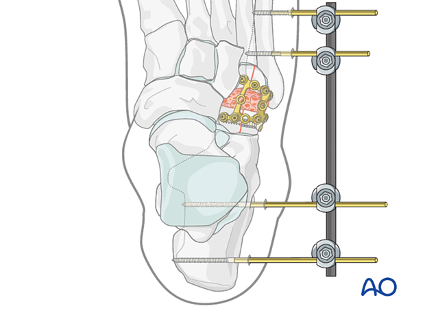 Temporary bridging for supplementing the cuboid plate fixation with an external fixator