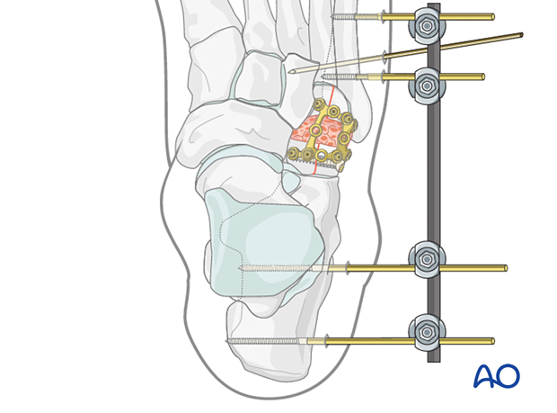 Temporary bridging for supplementing the cuboid plate fixation with an external fixator and additional K-wire fixation of the lateral cuneiform with the 4th and 5th metatarsal