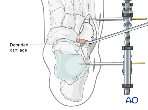Removal of the cartilage from the anterior facet of the calcaneum using a curette