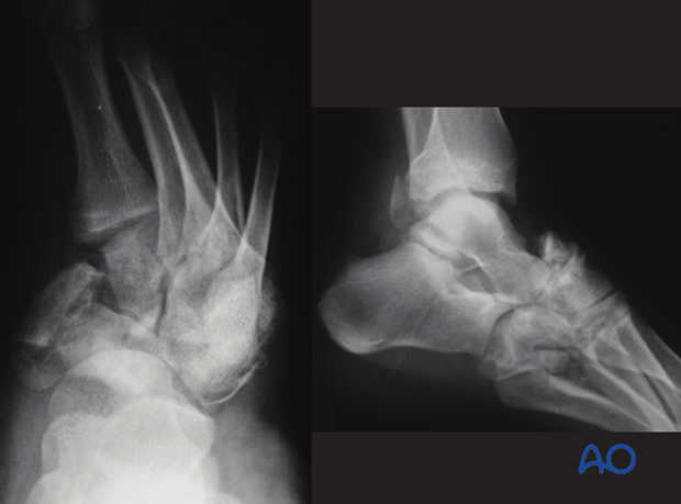 This case shows a severe Chopart injury in oblique and lateral x-rays.