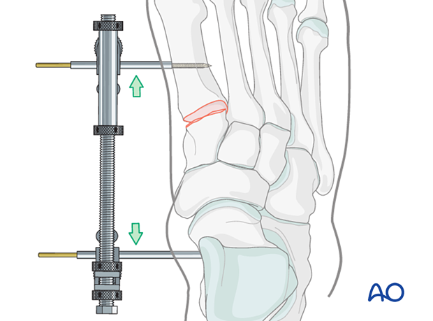 Restoration of medial-column length for fusion of the first tarsometatarsal joint